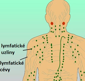 Non-Hodgkinův lymfom je nejrozšířenějším druhem zhoubného nádoru lymfatického systému. 