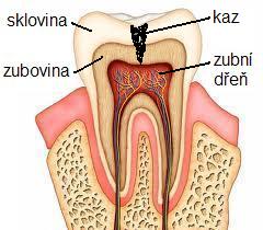 Za bolesti zubů je zánět nebo podráždění zubní dřeně