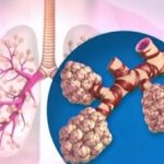 Rehabilitace u nemocných s chronickou obstrukční plicní nemocí (CHOPN)