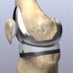 Totální endoprotéza kolenního kloubu – rehabilitace