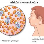 Infekční mononukleóza neboli nemoc z líbání – příznaky, léčba a jídelníček