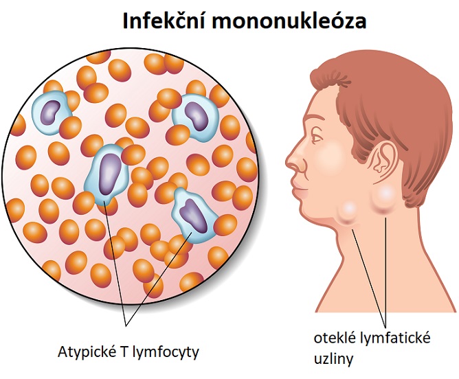 Infekční mononukleóza - ilustrace