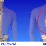 Jak na skoliózu? Zkuste naše tipy na domácí terapii a léčbu skoliózy.