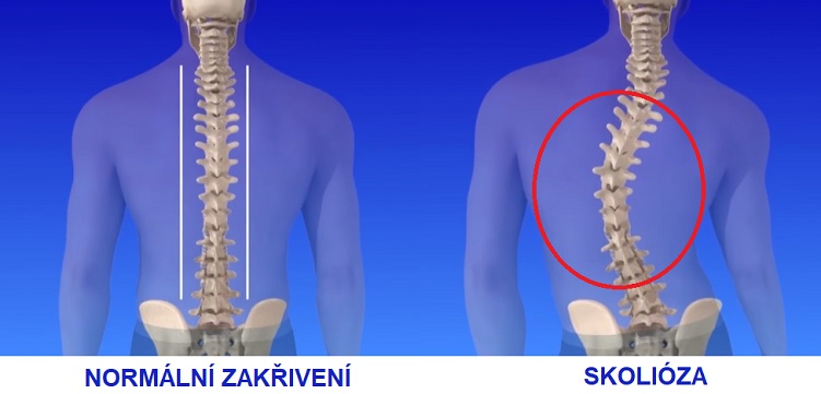 Porovnání páteře bez skoliózy a se skoliózou.