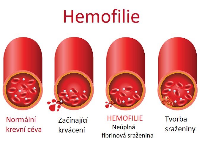 Hemofilie - ilustrace