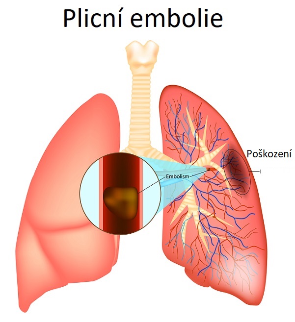 Plicní embolie je způsobena zablokovanou tepnou v plicích