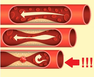 Cholesterol může ucpat jemné cévy na srdci (infarkt) nebo v mozku (mrtvice).