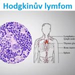 Hodgkinova choroba (Hodgkinův lymfom, rakovina lymfatického systému) – příznaky, příčiny a léčba