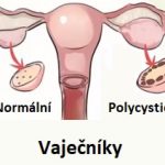 Syndrom polycystických vaječníků (ovarií), neboli PCOS syndrom – příznaky, příčiny a léčba