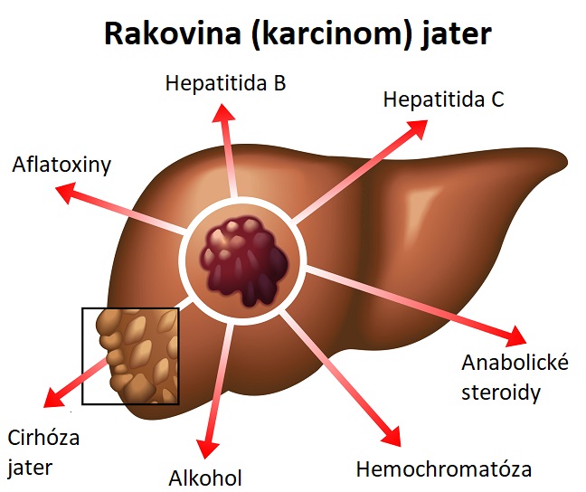 Příčiny rakoviny jater - ilustrace