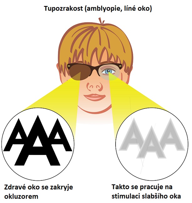 Tupozrakost (amblyopie, líné oko) - ilustrace