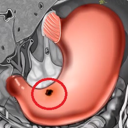 Jak na prevenci žaludečních vředů? Máme pro vás pár tipů.