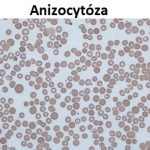 Anizocytóza erytrocytů – příznaky, příčiny a léčba