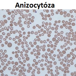 Anizocytóza je lékařský termín, který znamená, že červené krvinky pacienta nemají stejnou velikost. Obvykle se vyskytuje u anémie a jiných krevních problémů.