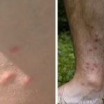 Cerkariální (cerkáriová) dermatitida – příznaky, příčiny a léčba