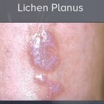 Lichen planus – příznaky, příčiny a léčba