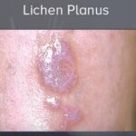 Lichen planus – příznaky, příčiny a léčba