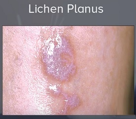 Lichen planus je kožní vyrážka