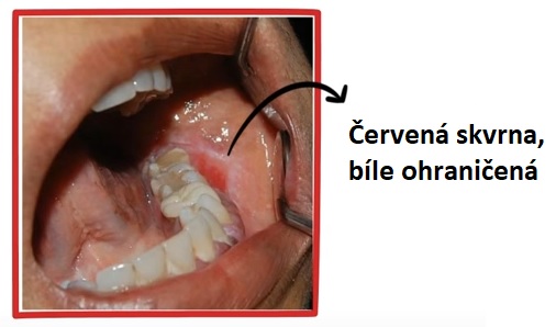 Takto může vypadat Lichen planus v ústech
