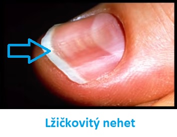 Lžičkovité nehty mohou být příznakem nedostatku železa v těle.