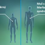 Marfanův syndrom (dolichostenomelie) – příznaky, příčiny, léčba