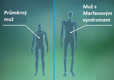 Dlouhé končetiny a dlouhé tělo jsou jedním z příznaků Marfanova syndromu.