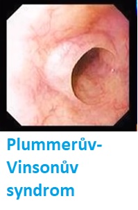 Plummerův-Vinsonův syndrom