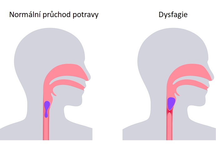 Dysfagie - ilustrace