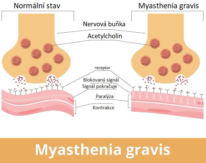 Myasthenia gravis - ilustrace