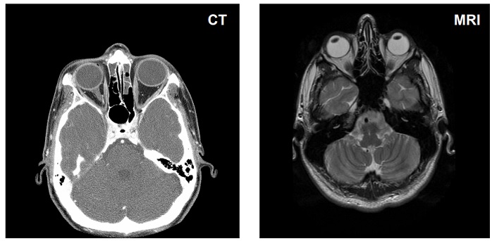 Porovnání zobrazení CT a MRI