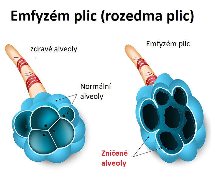 Emfyzém plic - ilustrace