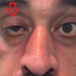 Myasthenia gravis – těžká svalová slabost – příčiny, příznaky, léčba