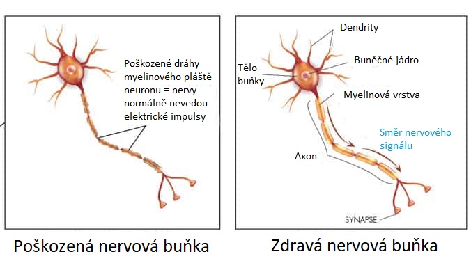 Zdravá a poškozená nervová buňka (neuron)