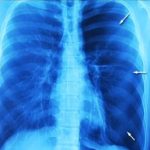 Zhroucená plíce (pneumotorax, kolaps plic) – příznaky, příčiny, léčba