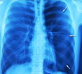 Pneumotorax můžeme zjednodušeně definovat jako přítomnost vzduchu v pleurální dutině.