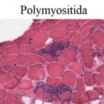 Polymyositida – příznaky, příčiny a léčba