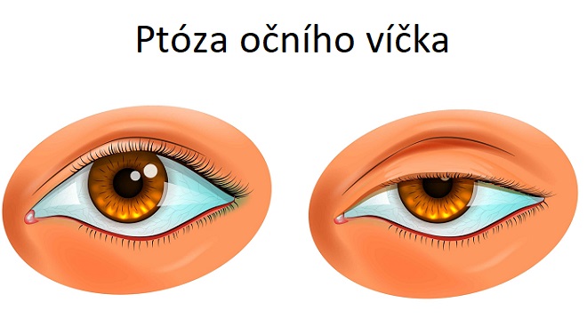 Ptóza očního víčka - ilustrace
