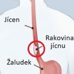 Rakovina jícnu – příznaky, příčiny a léčba