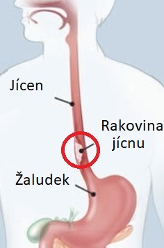 Rakovina jícnu je šestou nejčastější příčinou úmrtí na rakovinu po celém světě.