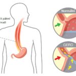 Barrettův jícen – poškození sliznice jícnu – příznaky, příčiny a léčba