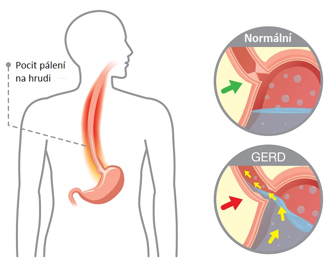 Refluxní choroba jícnu neboli gastroezofageální reflux (GERD) - ilustrace
