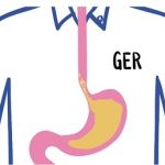 Refluxní choroba jícnu neboli gastroezofageální reflux (GERD) – příznaky, příčiny a léčba