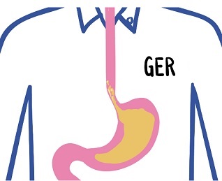 Ve většině případů lze gastroezofageální reflux (GERD) zlehčit změnami stravy a životního stylu.