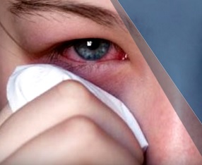 Jedním z hlavních příznaků Sjogrenova syndromu jsou suché oči.