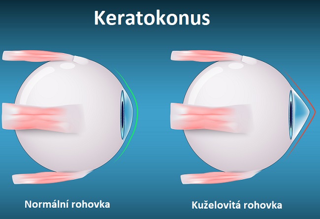 Keratokonus - ilustrace