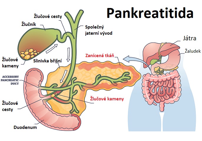 Pankreatitida je zánět pankreatu (slinivky) - ilustrace