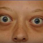 Gravesova oftalmopatie – co je to?