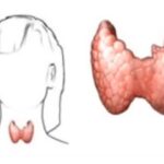Graves-Basedowova choroba (Gravesova choroba) – příčiny, příznaky a léčba