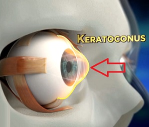 Keratokonus je progresivní oční onemocnění, při kterém normálně kulatá rohovka vybledne a začne se tvarovat do kuželovitého tvaru