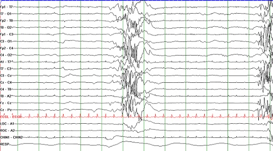 EEG - Ohtahara syndrom